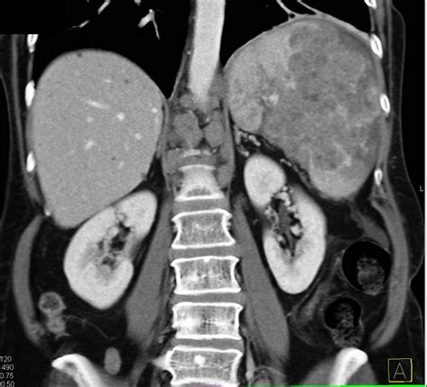Lymphoma With Adenopathy And Liver And Splenic Involvement Liver Case