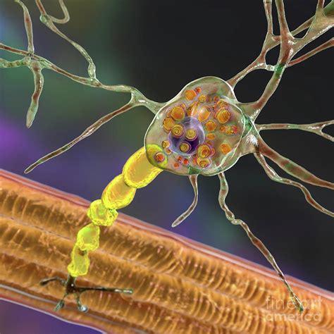 Neurons In Tay Sachs Disease Photograph By Kateryna Kon Science Photo Library Pixels