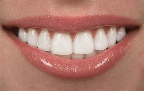 This small additional charge depends on the complexity of your dental needs and the number of veneers. How Much Do Porcelain Veneers Cost?