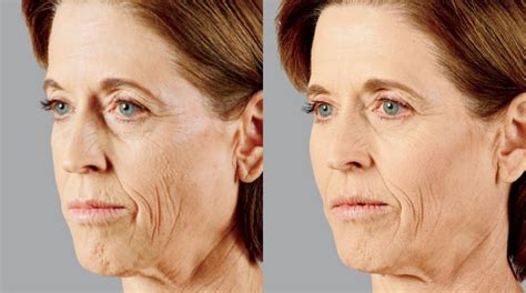 Face Fillers Before And After Photos