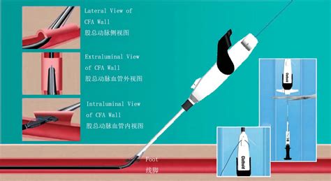 Disposable Vascular Closure Device Weiyuan Medical Device