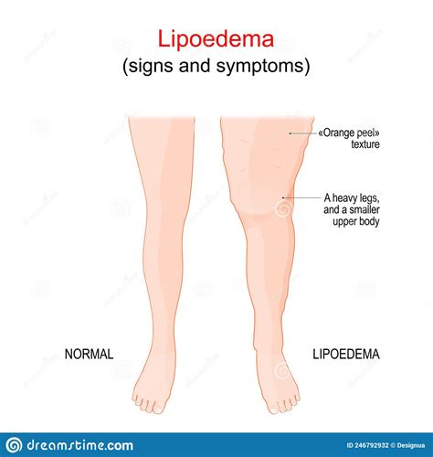 Lipoedema Or Lipedema Stock Vector Illustration Of Lipedema 246792932
