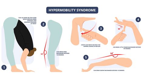 Joint Hypermobilty Do You Have This Common Yogi Condition