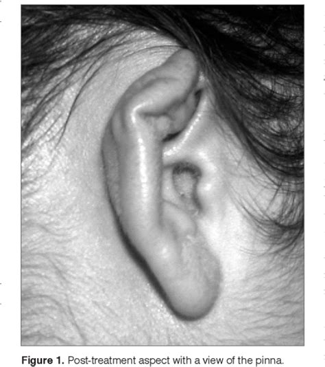 Figure 1 From Auricular Perichondritis By Piercing Complicated With