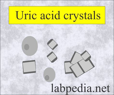 Urine Crystals Crystalluria Labpedia Net