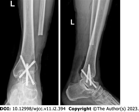 Management Of A Rare Giant Cell Tumor Of The Distal Fibula A Case Report