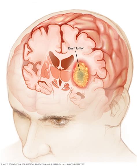 Brain Tumor Symptoms And Causes Mayo Clinic
