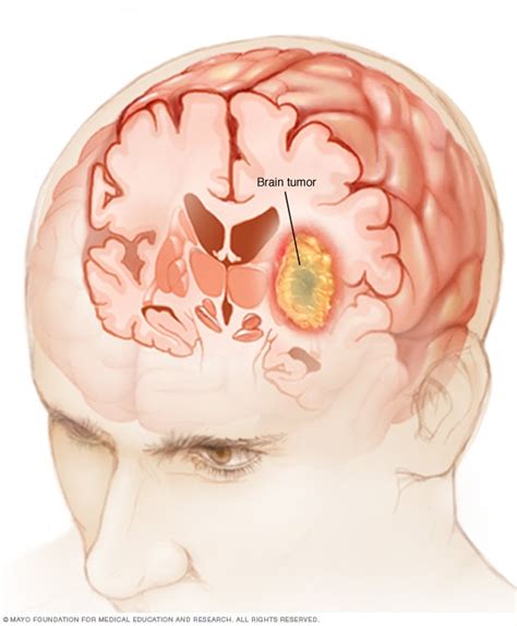 Tumor Cerebral Síntomas Y Causas Mayo Clinic