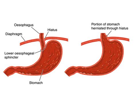 Find the perfect hiatal hernia stock photos and editorial news pictures from getty images. Hiatal Hernia - Los Angeles Hemorrhoid Clinic