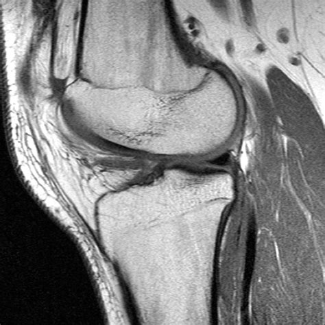 Synovial Plicae Of The Knee Radsource