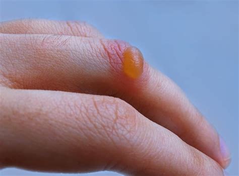 Blisters On Skin All You Need To Know About Natures Band Aid