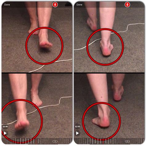 Over Pronation Of The Foot What Are The Treatments Maxinemyslinskis