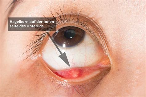 Hagelkorn Im Auge Geht Nicht Weg Definition Des Hagelkorns Chalazion