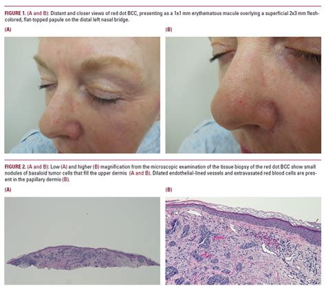 Red Dot Basal Cell Carcinoma An Unusual Variant Of A Common Malignancy