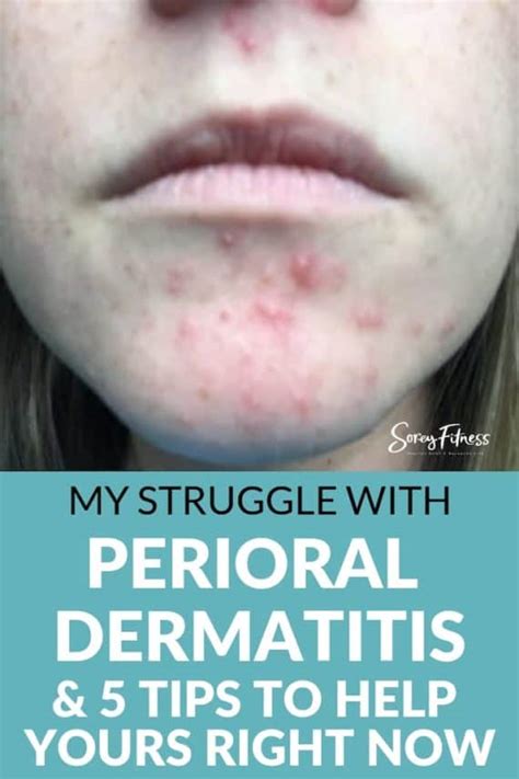Perioral Dematitis Products And Treatments That Helped My Skin Quickly