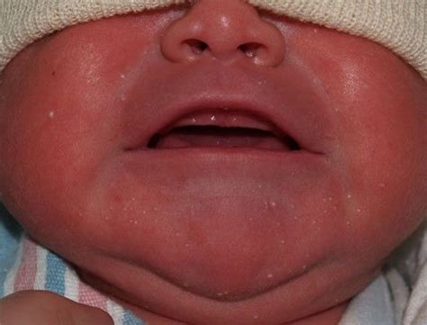 Milia White Papules On Chin And Cheeks Common In Newborn Are