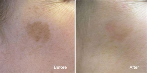 Remove Age Spots Sun Spots Skin Pigmentation At Bc Laser