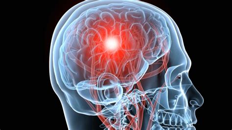 Can Symptoms Of Traumatic Brain Injury Show Up Years After An Injury