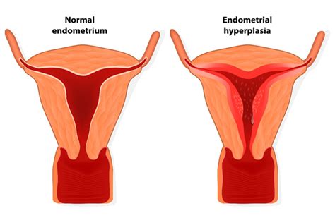 Abnormal Uterine Bleeding In Perimenopausal Women Promedicalaid