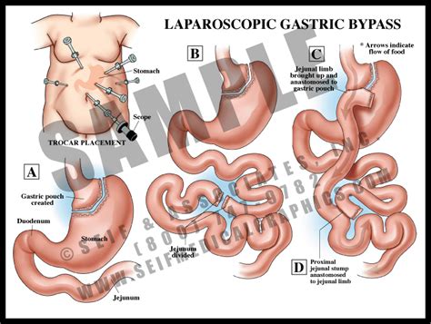Gastric Bypass Sanda Medical Graphics