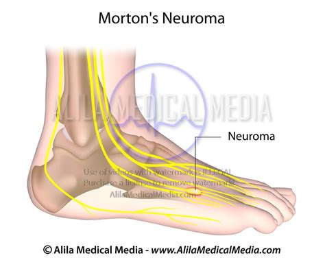 Alila Medical Media Nerves Of Foot Medical Illustration