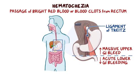 Approach To Hematochezia Clinical Sciences Osmosis Video Library