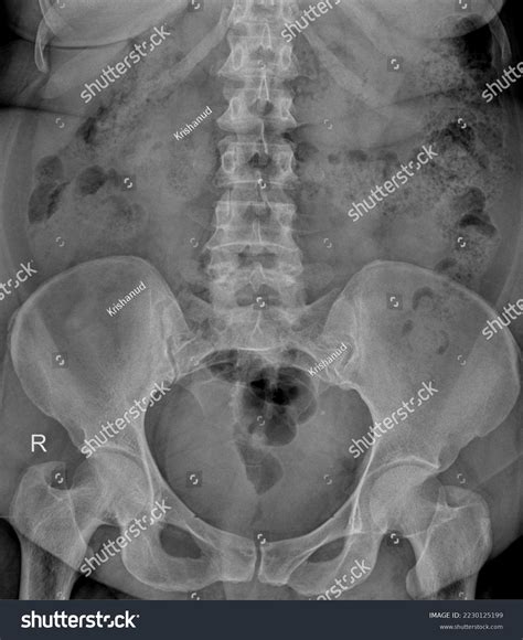 Xray Image Plain Kub Kidney Ureterbladder Stock Photo 2230125199