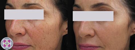 Laser Treatment To Remove Age Spots