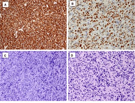 Tumor Histology High Grade Diffuse Large B Cell Lymphoma With