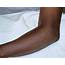 Elbow Dislocation  Pediatric Pediatrics Orthobullets