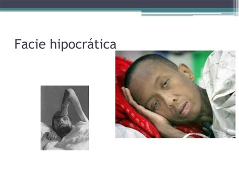 Facies Hippocratica