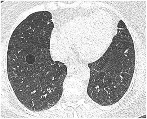 Pulmonary Cysts Identified On Chest Ct Are They Part Of Aging Change