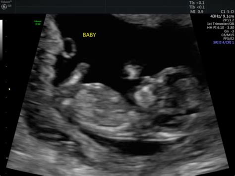 Fetal ultrasound of 12 weeks baby boy moving 3d. Boy or girl? 12 week ultrasound - ultrasound gender ...