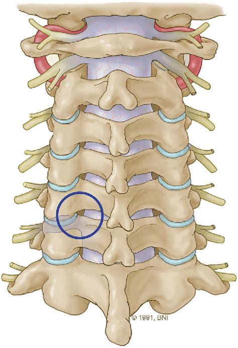 Figure From Minimally Invasive Foraminotomy Of The Cervical Spine Improving Technique And
