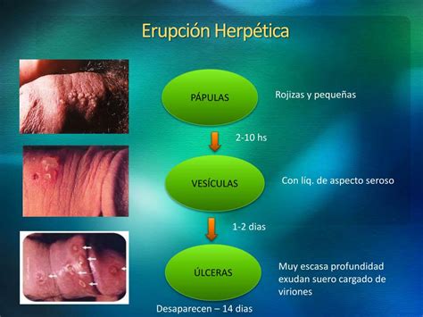Ppt Herpes Genital Y Embarazo Powerpoint Presentation Free Download Id 3803756
