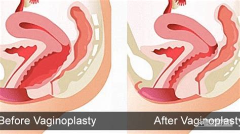 Vaginoplasty Surgery Hymenoplasty Revirgination Vaginal Plastic