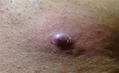 Ingrown Hair Cyst Pictures Removal Treatment Causes