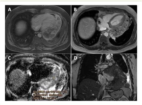 Figure 3 From A Case Report Of Malignant Primary Pericardial