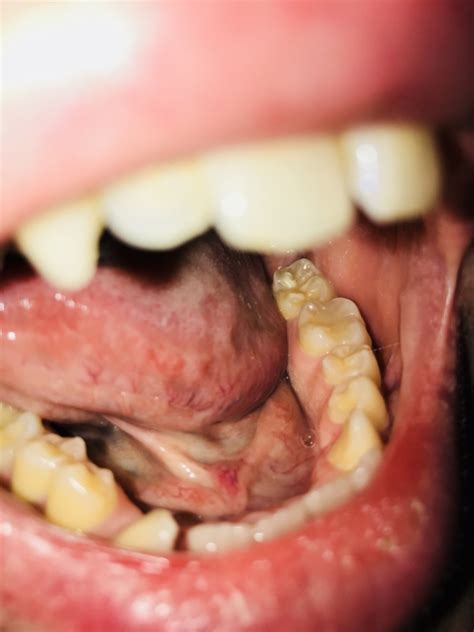 White Spots On Gums Yellow Tongue And Mouth Discomfort Oral And