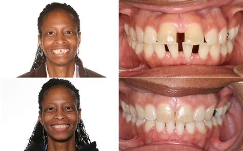 Before And After Braces Adults