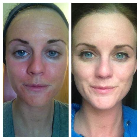 Maskcara & Moscato: Chemical Peels