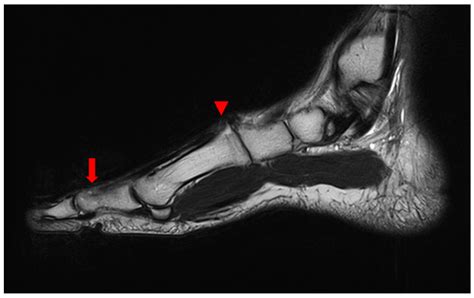 Medicina Free Full Text A Neglected Extensor Hallucis Longus Tendon Rupture Caused By