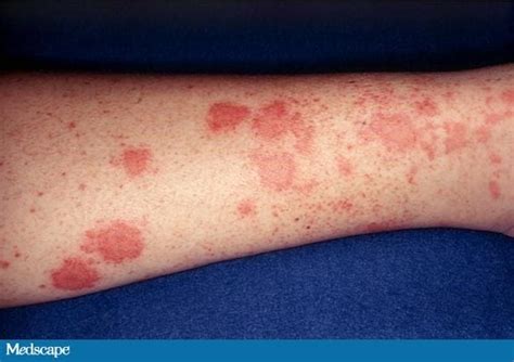 A 58 Year Old Man With A Rash And Elevated Creatinine Levels