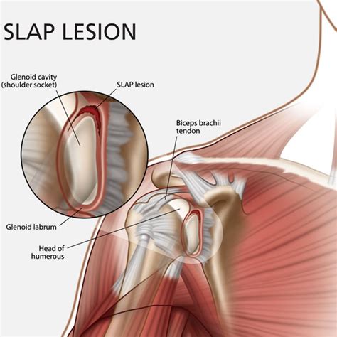 A selection of frequent lesions encountered by. Glenoid Labrum Tear: SLAP Lesion - Shoulder Pain ...