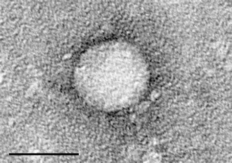 Hepatitis C Wikipedia