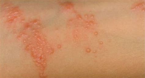 Fungal Skin Rash On Arm Dibandingkan