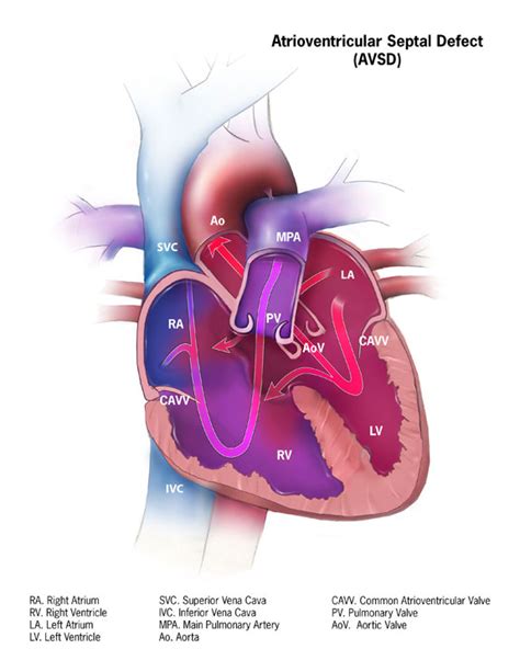 Cdc Congenital Heart Defects Avsd Graphic Ncbddd