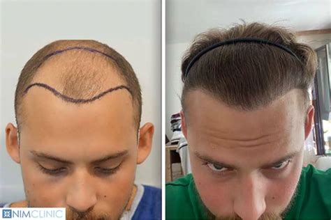 Top 20 Best Hair Transplants In Turkey And Cost In 2023