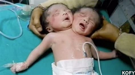 Rare Set Of Conjoined Twins Born In India Video