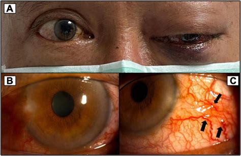 A More Severe Proptosis Of The Left Eye With Progressed Exophthalmos